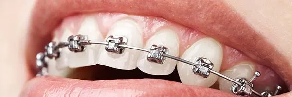 Self-Ligating Braces - Dental Planet